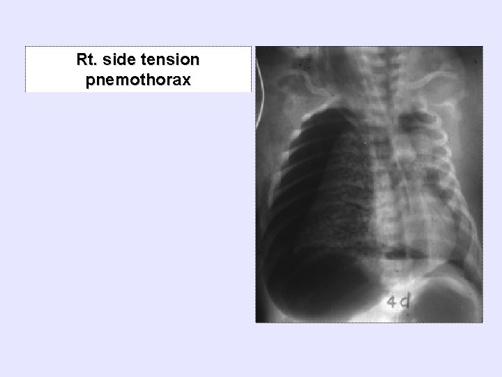 Rt. side tension pnemothorax 