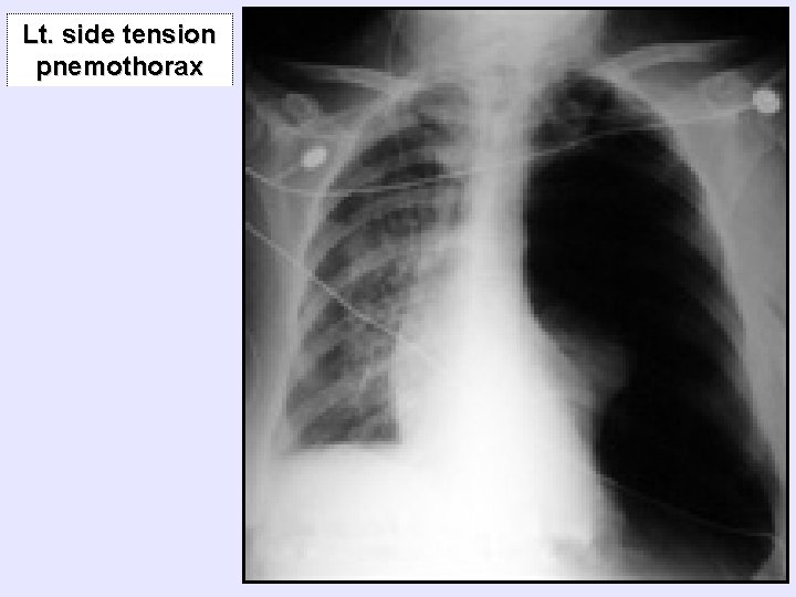 Lt. side tension pnemothorax 