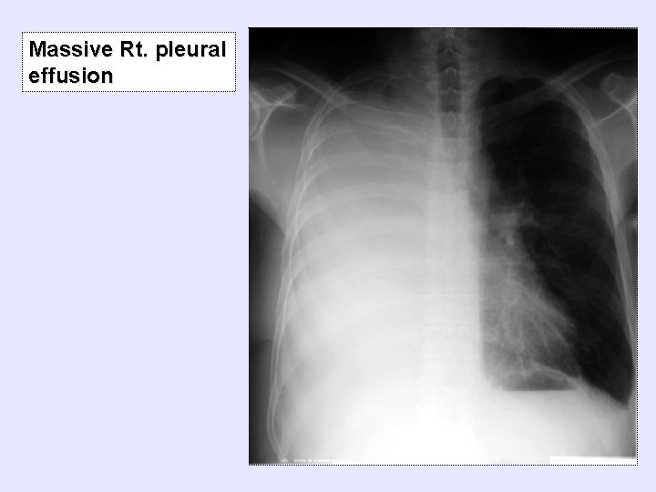 Massive Rt. pleural effusion 