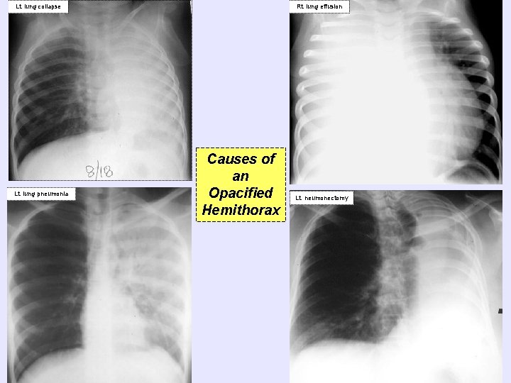 Lt. lung collapse Lt. lung pneumonia Rt. lung effusion Causes of an Opacified Hemithorax