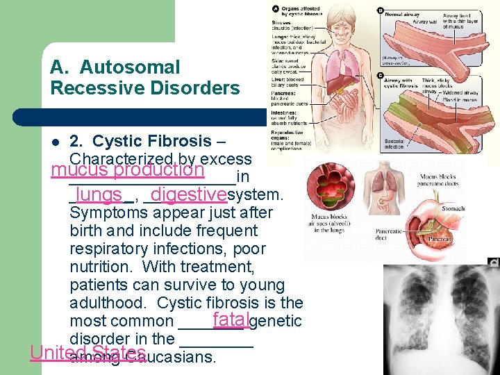 A. Autosomal Recessive Disorders 2. Cystic Fibrosis – Characterized by excess mucus production _________in