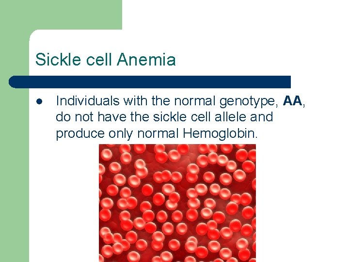 Sickle cell Anemia l Individuals with the normal genotype, AA, do not have the