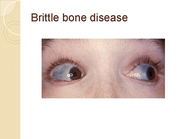 Brittle bone disease 