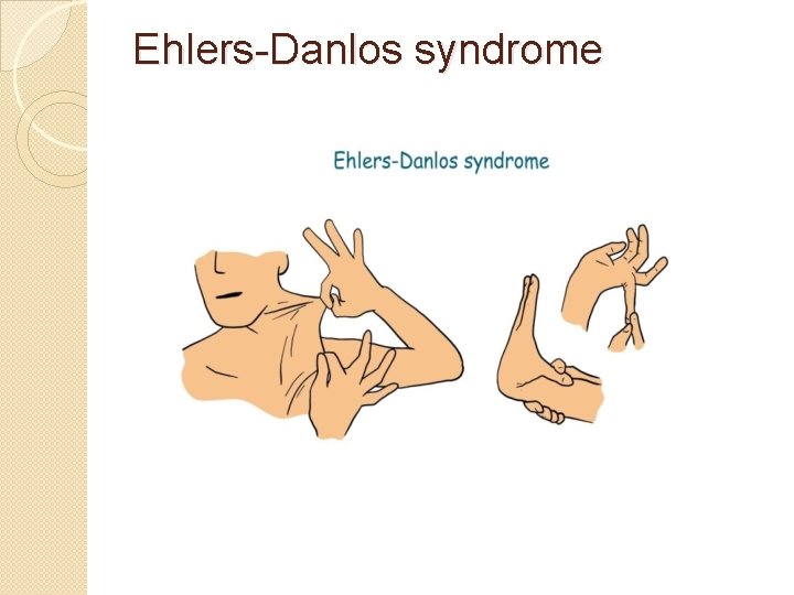 Ehlers-Danlos syndrome 
