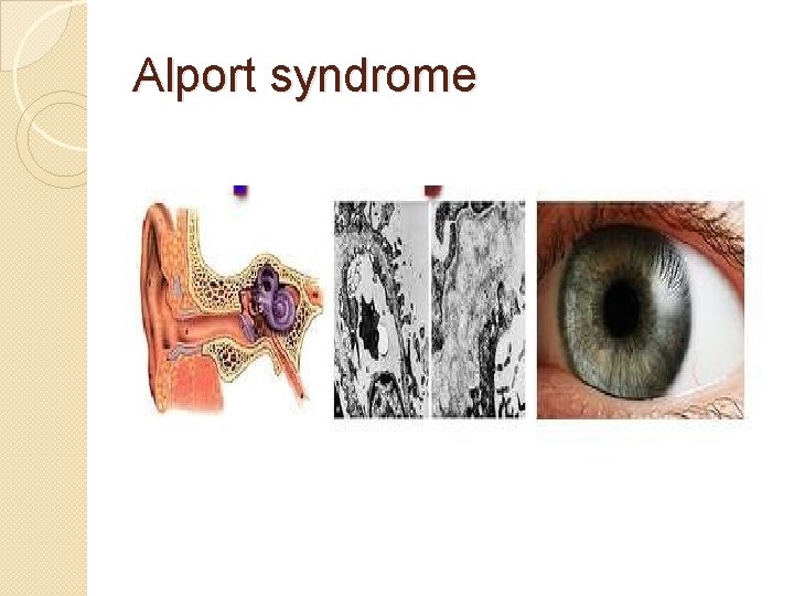 Alport syndrome 