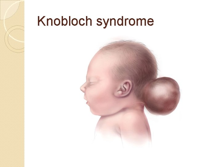 Knobloch syndrome 