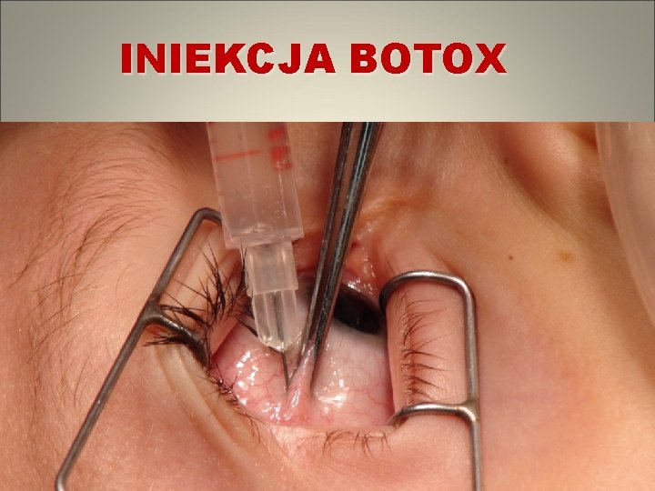 INIEKCJA BOTOX 