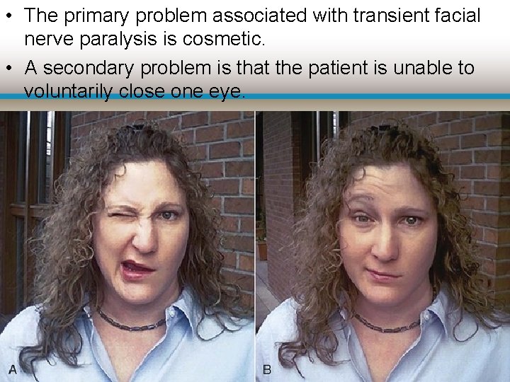  • The primary problem associated with transient facial nerve paralysis is cosmetic. •