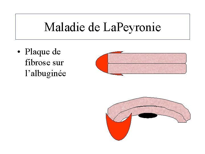 Maladie de La. Peyronie • Plaque de fibrose sur l’albuginée 