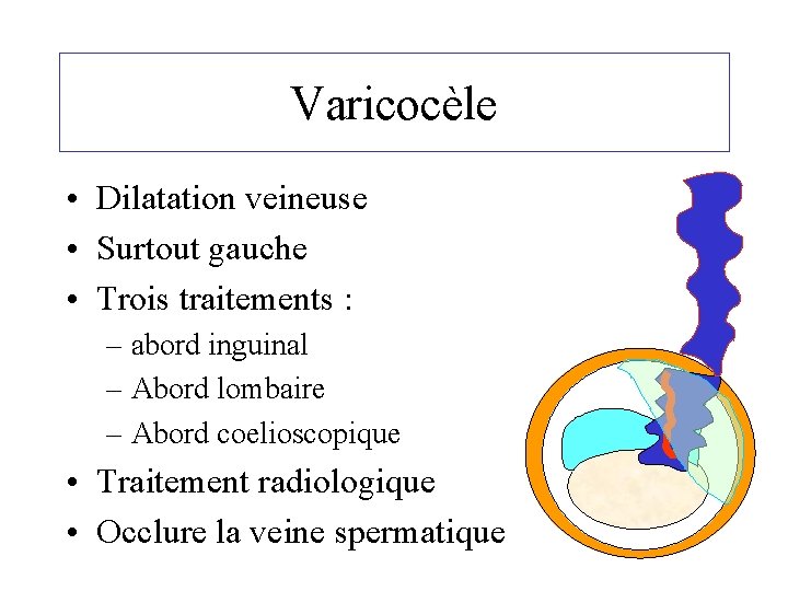 Varicocèle • Dilatation veineuse • Surtout gauche • Trois traitements : – abord inguinal