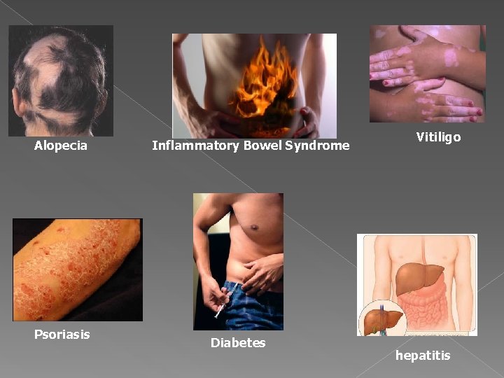 Alopecia Psoriasis Inflammatory Bowel Syndrome Diabetes Vitiligo hepatitis 