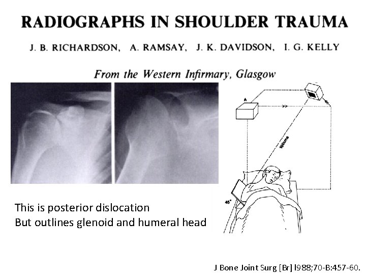 This is posterior dislocation But outlines glenoid and humeral head J Bone Joint Surg