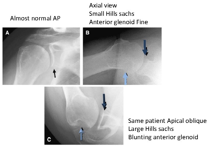 Almost normal AP Axial view Small Hills sachs Anterior glenoid Fine Same patient Apical