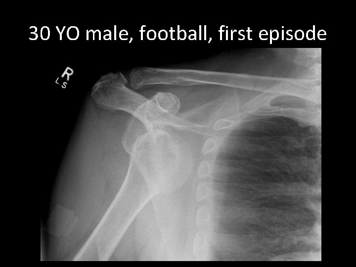 30 YO male, football, first episode 