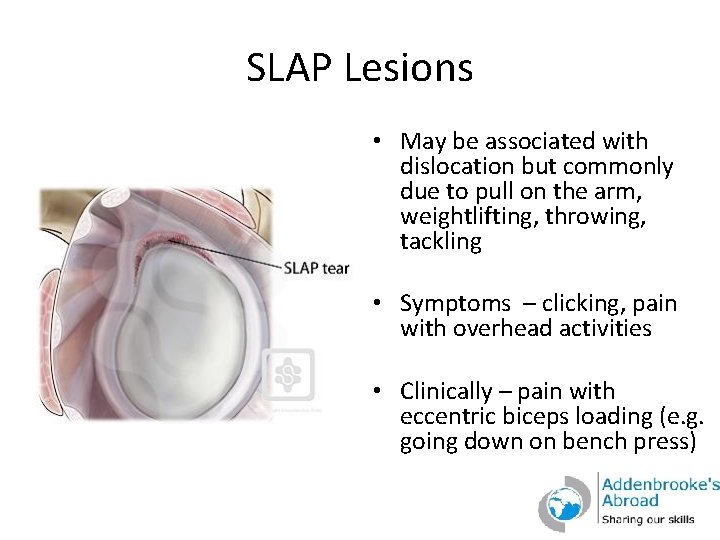 SLAP Lesions • May be associated with dislocation but commonly due to pull on