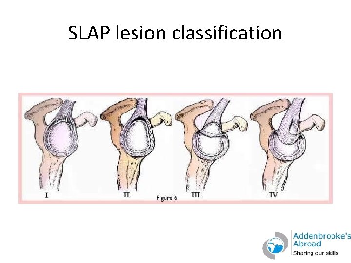 SLAP lesion classification 