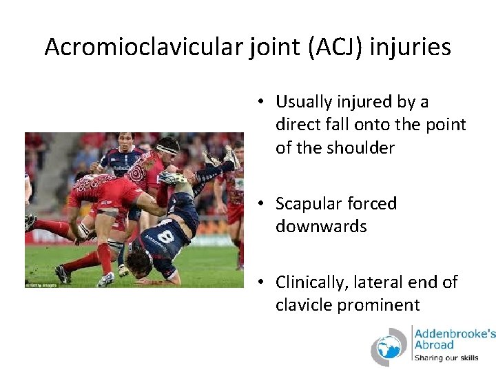 Acromioclavicular joint (ACJ) injuries • Usually injured by a direct fall onto the point