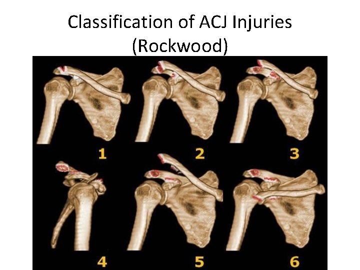 Classification of ACJ Injuries (Rockwood) 