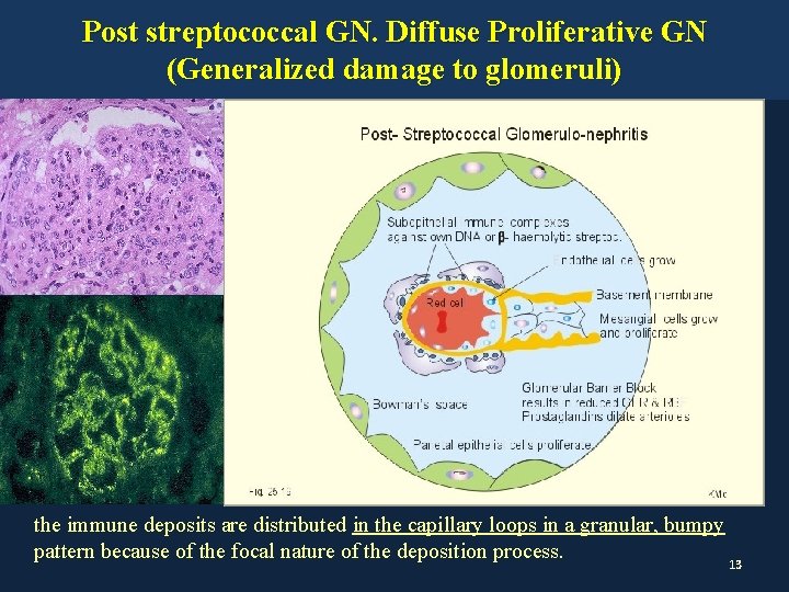 Post streptococcal GN. Diffuse Proliferative GN (Generalized damage to glomeruli) the immune deposits are