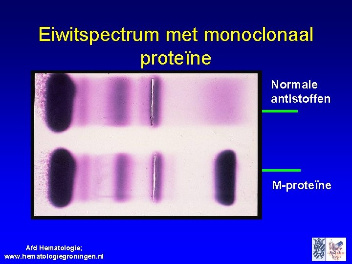 Eiwitspectrum met monoclonaal proteïne Normale antistoffen M-proteïne Afd Hematologie; www. hematologiegroningen. nl 