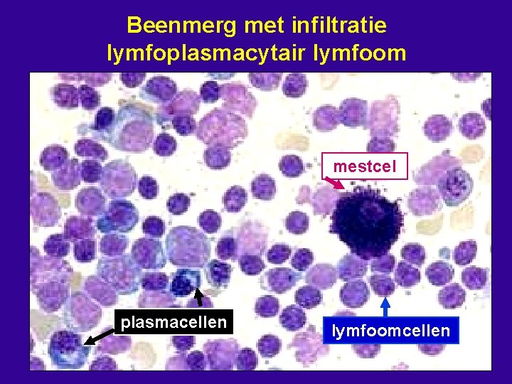 Beenmerg met infiltratie lymfoplasmacytair lymfoom mestcel plasmacellen lymfoomcellen 