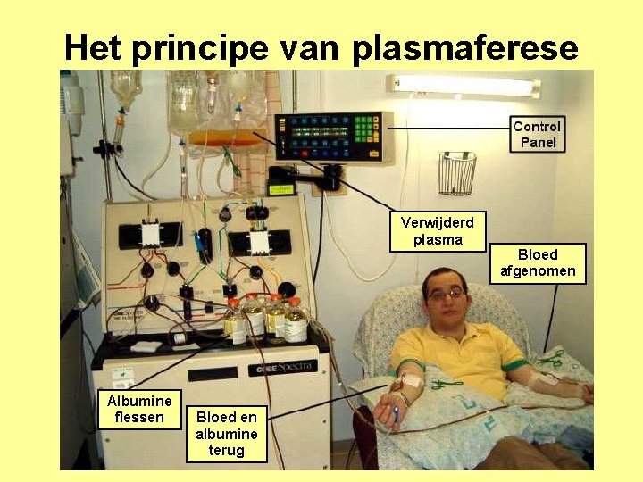 Het principe van plasmaferese Verwijderd plasma Albumine flessen Bloed en albumine terug Bloed afgenomen