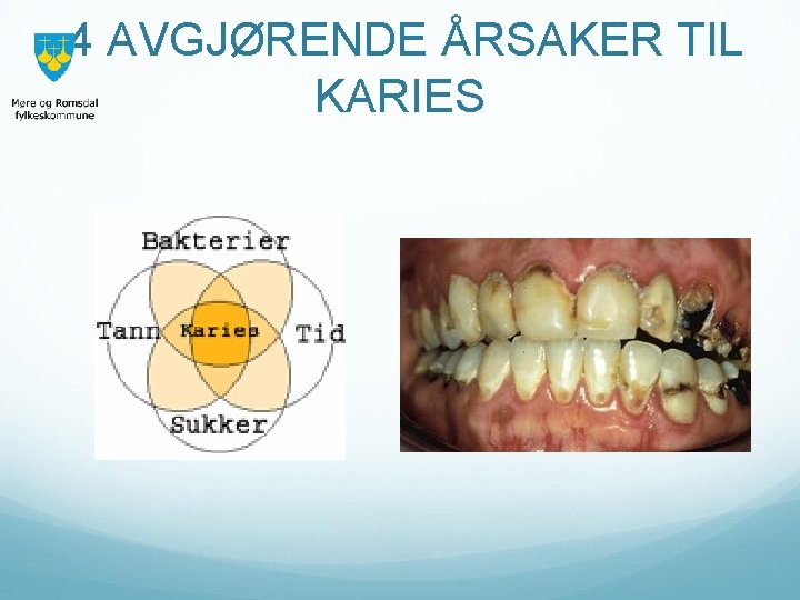 4 AVGJØRENDE ÅRSAKER TIL KARIES 