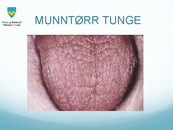 MUNNTØRR TUNGE 