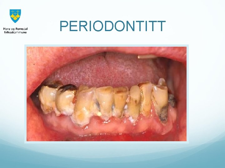 PERIODONTITT 