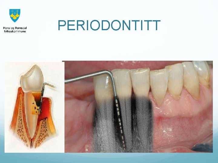 PERIODONTITT 