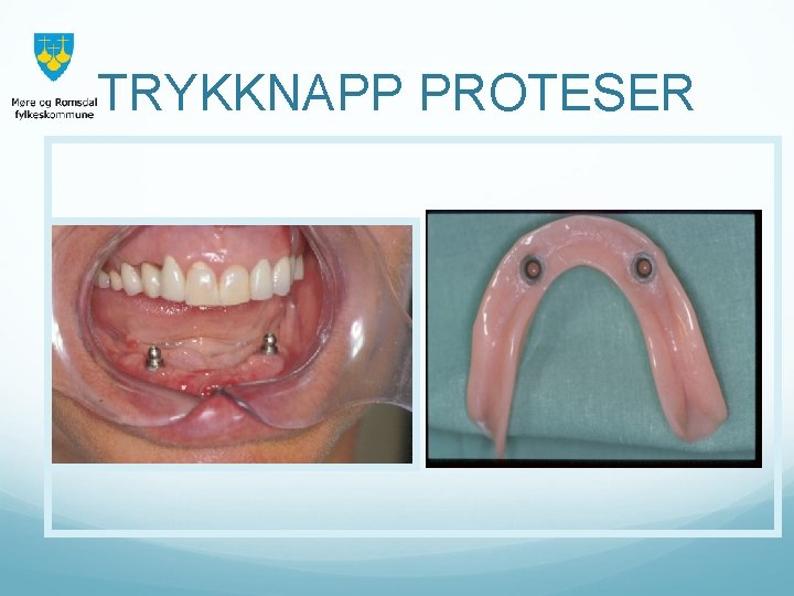 TRYKKNAPP PROTESER 