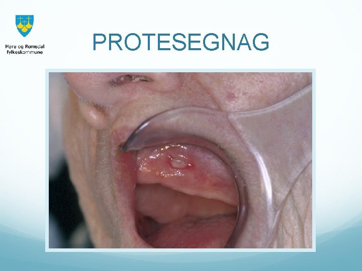 PROTESEGNAG 