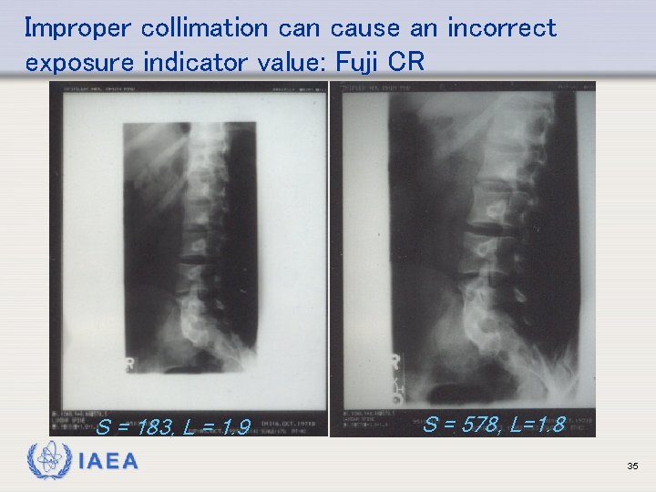 Improper collimation cause an incorrect exposure indicator value: Fuji CR S = 183, L