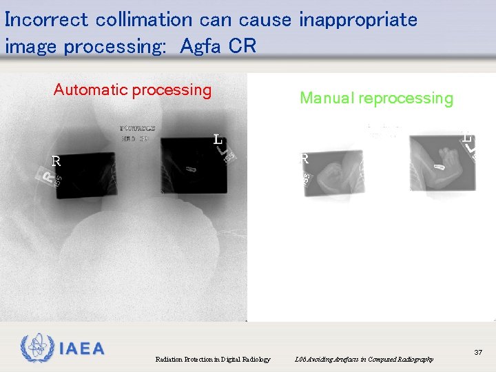 Incorrect collimation cause inappropriate image processing: Agfa CR Automatic processing IAEA Radiation Protection in