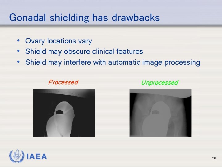 Gonadal shielding has drawbacks • Ovary locations vary • Shield may obscure clinical features