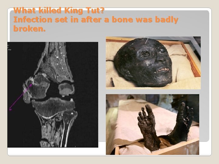 What killed King Tut? Infection set in after a bone was badly broken. 