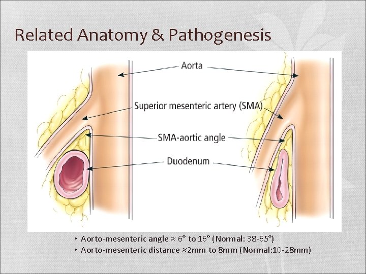 Related Anatomy & Pathogenesis • Aorto-mesenteric angle ≈ 6° to 16° (Normal: 38 -65°)