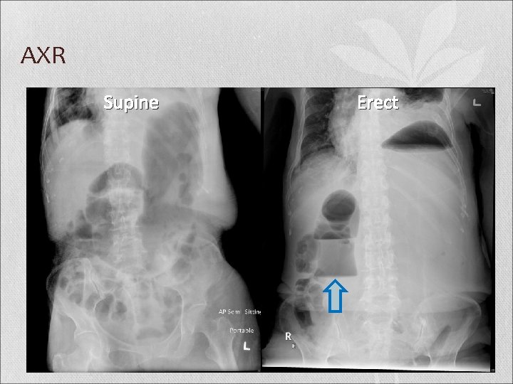 AXR Supine Erect 