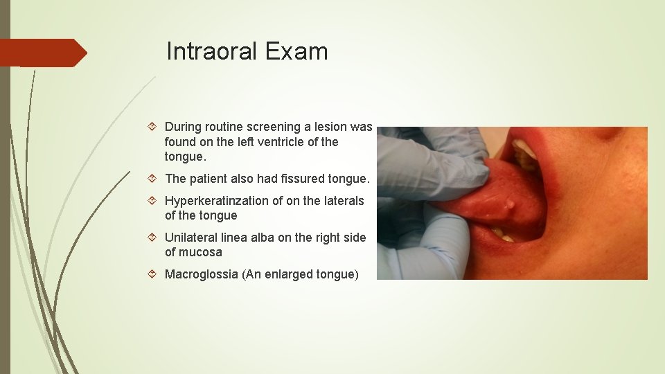Intraoral Exam During routine screening a lesion was found on the left ventricle of