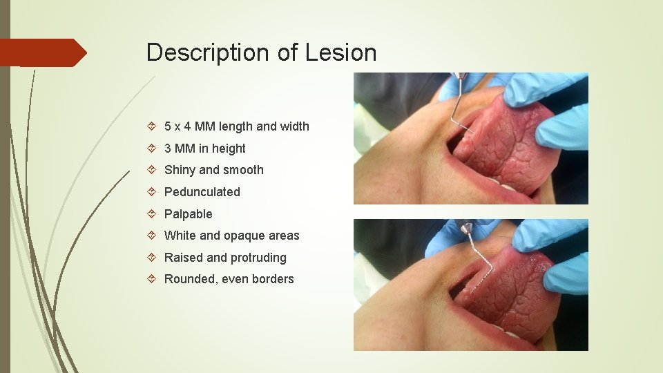Description of Lesion 5 x 4 MM length and width 3 MM in height