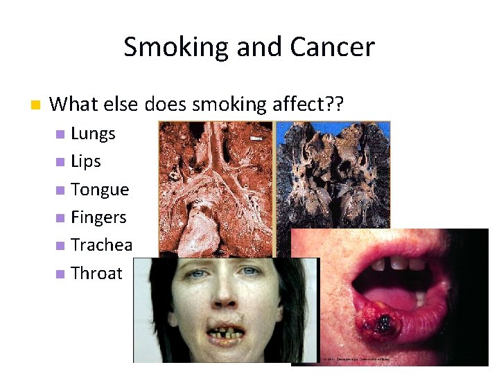 Smoking and Cancer n What else does smoking affect? ? Lungs n Lips n