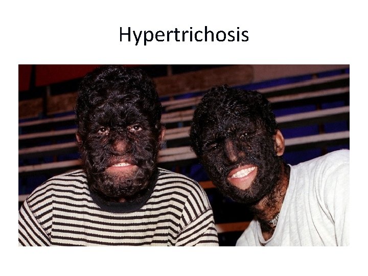 Hypertrichosis 