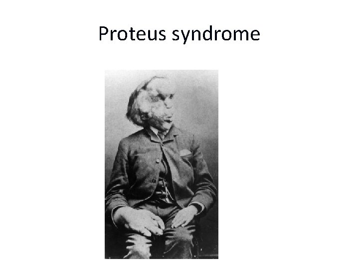 Proteus syndrome 