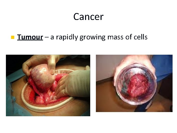 Cancer n Tumour – a rapidly growing mass of cells 