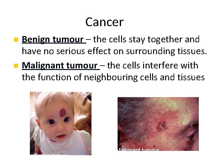 Cancer n n Benign tumour – the cells stay together and have no serious