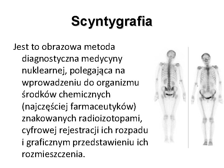 Scyntygrafia Jest to obrazowa metoda diagnostyczna medycyny nuklearnej, polegająca na wprowadzeniu do organizmu środków