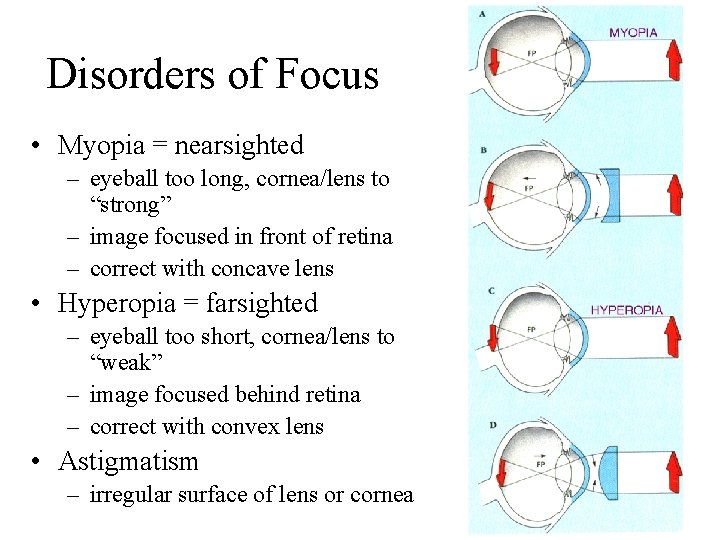 Disorders of Focus • Myopia = nearsighted – eyeball too long, cornea/lens to “strong”