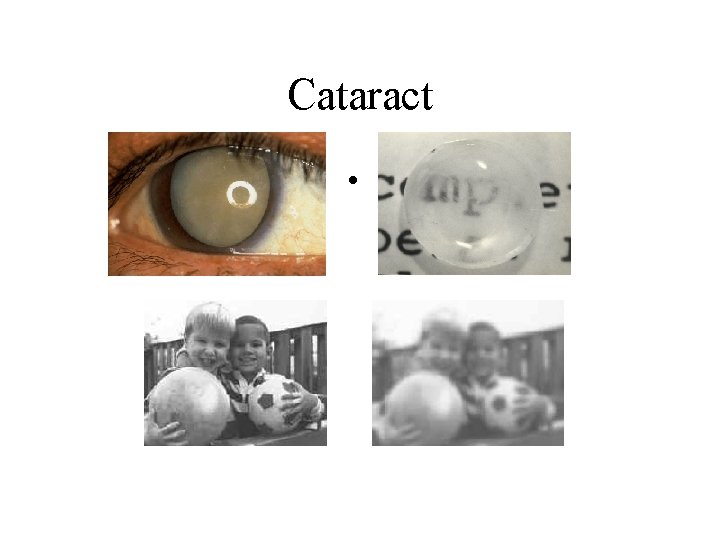 Cataract • 