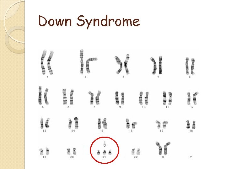 Down Syndrome Down Syndrome