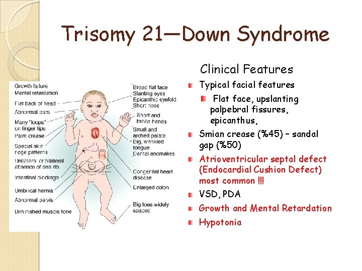 Trisomy 21—Down Syndrome Clinical Features Typical facial features Flat face, upslanting palpebral fissures, epicanthus, Trisomy 21—Down Syndrome Clinical Features Typical facial features Flat face, upslanting palpebral fissures, epicanthus,